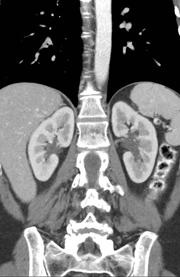 Echo en scan van de nieren