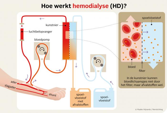 Hemodialyse in het kort